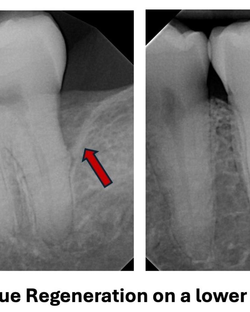 Guided Tissue Regeneration